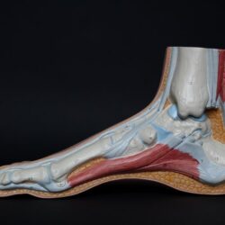 fascitis-plantar-fisioterapia